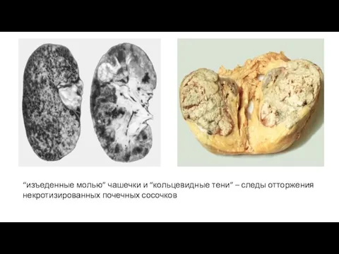 “изъеденные молью” чашечки и “кольцевидные тени” – следы отторжения некротизированных почечных сосочков