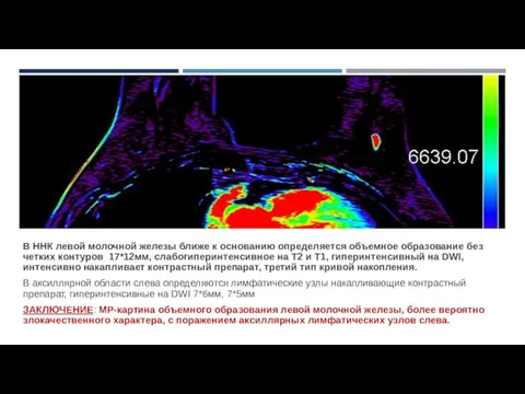 В ННК левой молочной железы ближе к основанию определяется объемное образование без