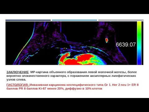 ЗАКЛЮЧЕНИЕ: МР-картина объемного образования левой молочной железы, более вероятно злокачественного характера, с