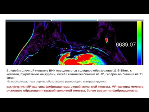 В левой молочной железе в ВНК определяется солидное образование 11*6*15мм, с четкими,