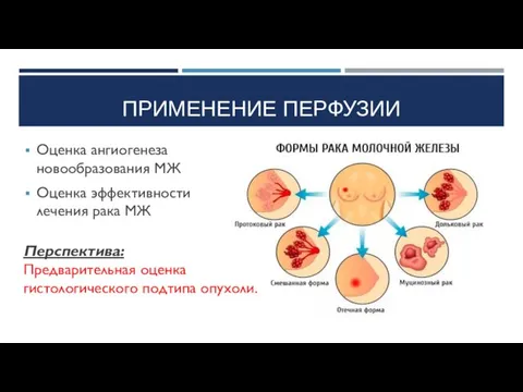 ПРИМЕНЕНИЕ ПЕРФУЗИИ Оценка ангиогенеза новообразования МЖ Оценка эффективности лечения рака МЖ Перспектива: