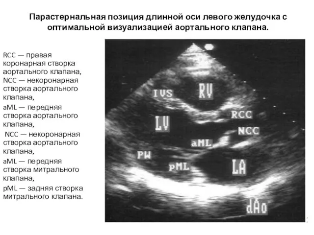 Парастернальная позиция длинной оси левого желудочка с оптимальной визуализацией аортального клапана. RCC