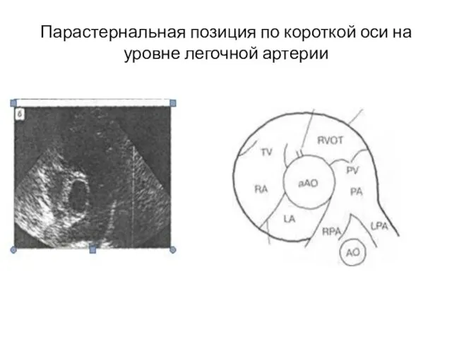 Парастернальная позиция по короткой оси на уровне легочной артерии