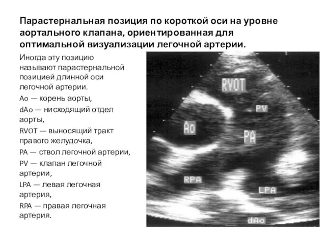 Парастернальная позиция по короткой оси на уровне аортального клапана, ориентированная для оптимальной