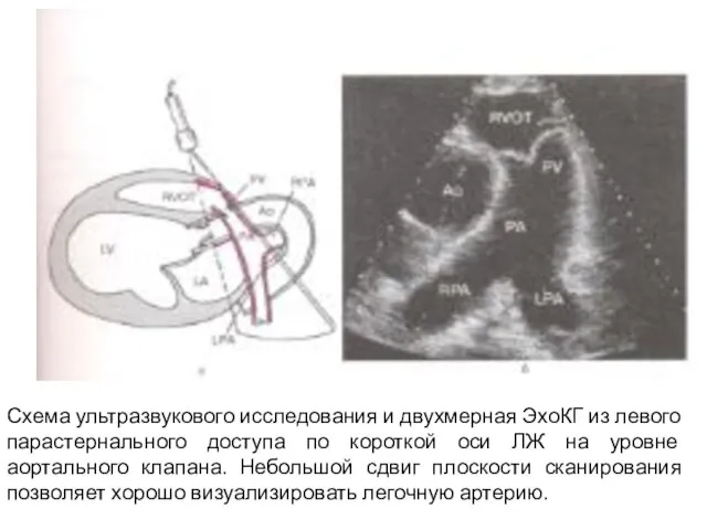 Схема ультразвукового исследования и двухмерная ЭхоКГ из левого парастернального доступа по короткой