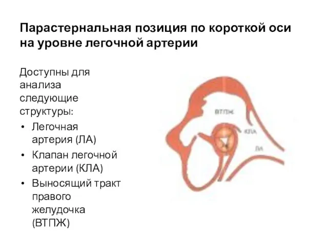 Парастернальная позиция по короткой оси на уровне легочной артерии Доступны для анализа