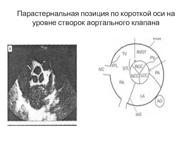 Парастернальная позиция по короткой оси на уровне створок аортального клапана