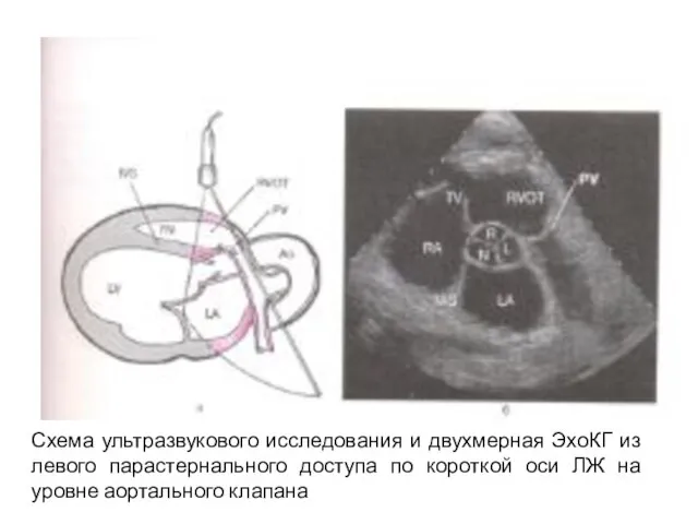 Схема ультразвукового исследования и двухмерная ЭхоКГ из левого парастернального доступа по короткой