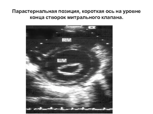 Парастернальная позиция, короткая ось на уровне конца створок митрального клапана.