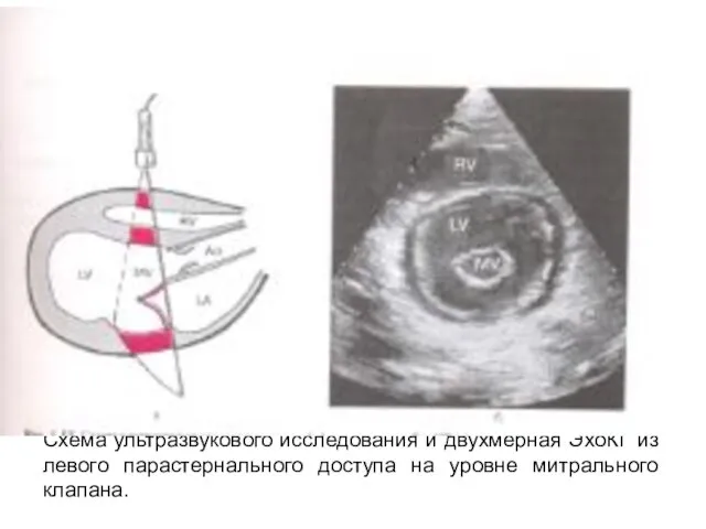 Схема ультразвукового исследования и двухмерная ЭхоКГ из левого парастернального доступа на уровне митрального клапана.