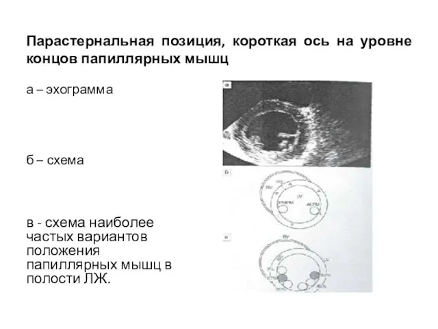 Парастернальная позиция, короткая ось на уровне концов папиллярных мышц а – эхограмма