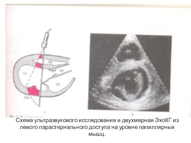 Схема ультразвукового исследования и двухмерная ЭхоКГ из левого парастернального доступа на уровне папиллярных мышц.