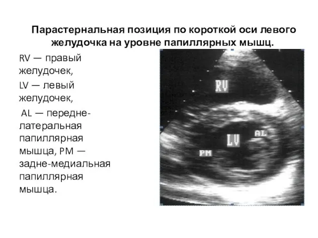 Парастернальная позиция по короткой оси левого желудочка на уровне папиллярных мышц. RV