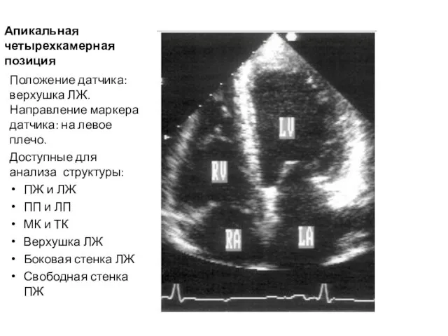 Апикальная четырехкамерная позиция Положение датчика: верхушка ЛЖ. Направление маркера датчика: на левое