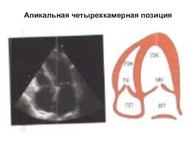 Апикальная четырехкамерная позиция