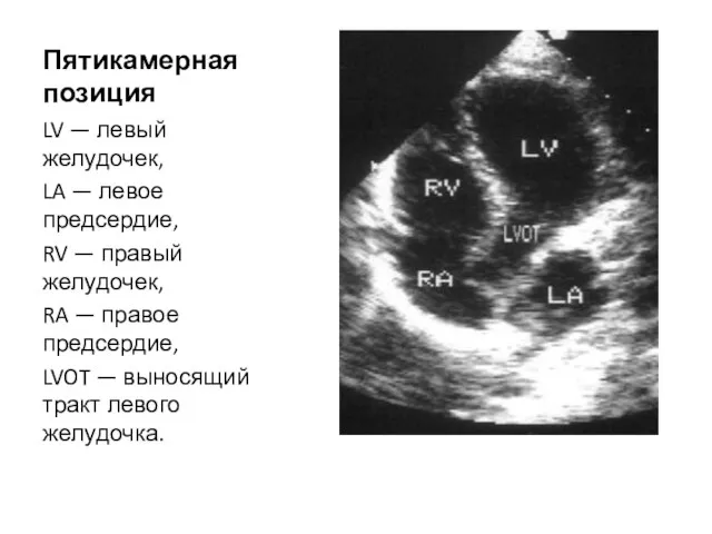Пятикамерная позиция LV — левый желудочек, LA — левое предсердие, RV —