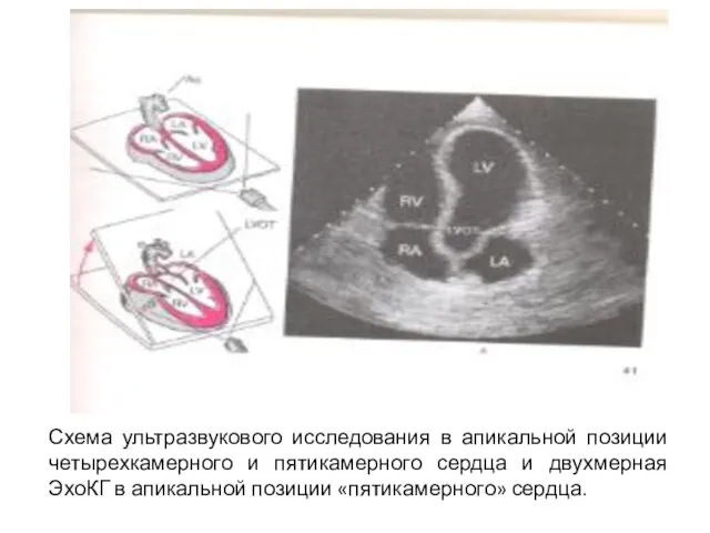 Схема ультразвукового исследования в апикальной позиции четырехкамерного и пятикамерного сердца и двухмерная