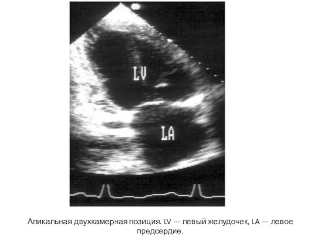 Апикальная двухкамерная позиция. LV — левый желудочек, LA — левое предсердие.