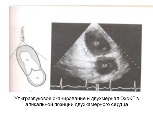 Ультразвуковое сканирование и двухмерная ЭхоКГ в апикальной позиции двухкамерного сердца