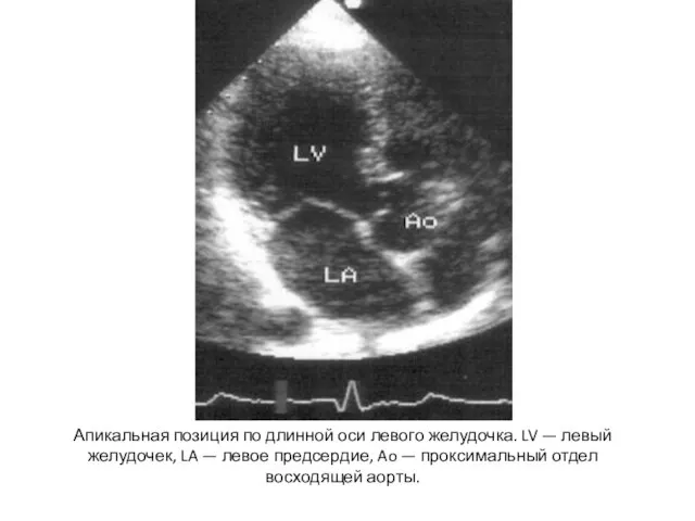 Апикальная позиция по длинной оси левого желудочка. LV — левый желудочек, LA
