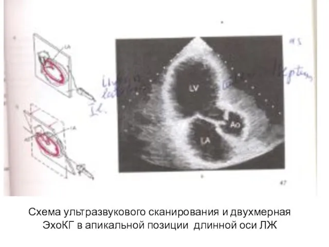 Схема ультразвукового сканирования и двухмерная ЭхоКГ в апикальной позиции длинной оси ЛЖ