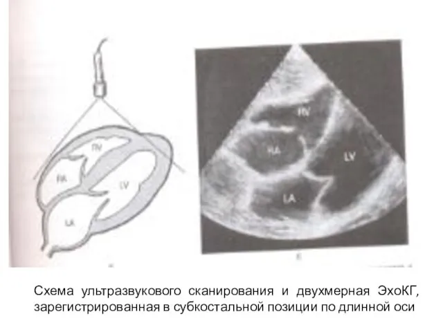 Схема ультразвукового сканирования и двухмерная ЭхоКГ, зарегистрированная в субкостальной позиции по длинной оси