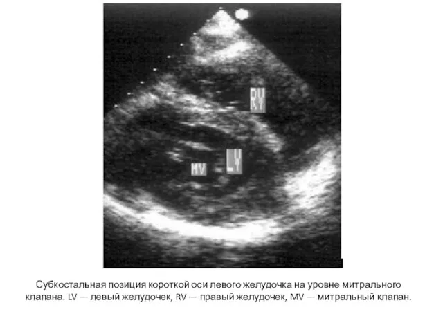 Субкостальная позиция короткой оси левого желудочка на уровне митрального клапана. LV —