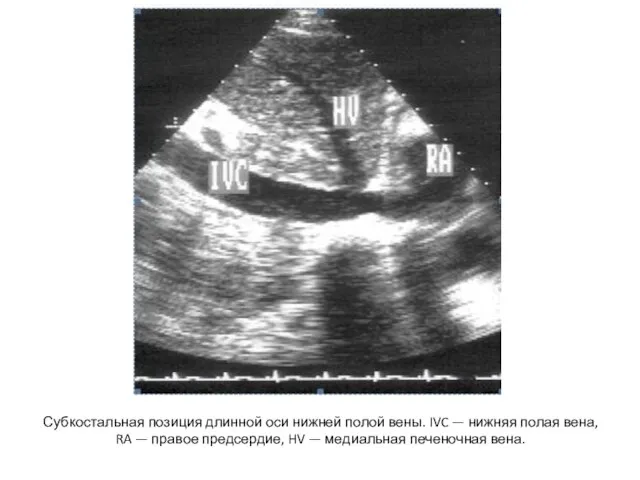Субкостальная позиция длинной оси нижней полой вены. IVC — нижняя полая вена,