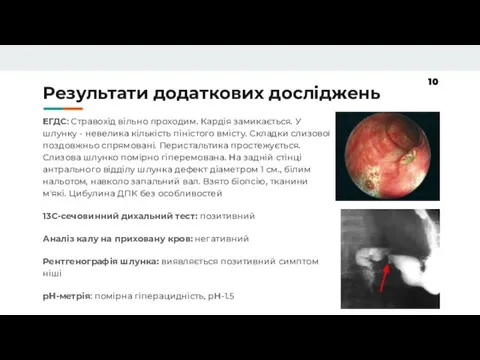 Результати додаткових досліджень ЕГДС: Стравохід вільно проходим. Кардія замикається. У шлунку -