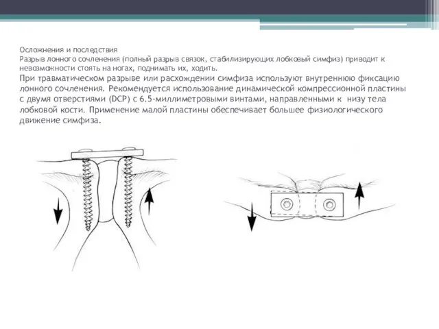 Осложнения и последствия Разрыв лонного сочленения (полный разрыв связок, стабилизирующих лобковый симфиз)