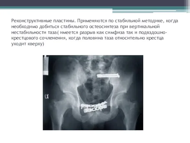 Реконструктивные пластины. Применяются по стабильной методике, когда необходимо добиться стабильного остеосинтеза при