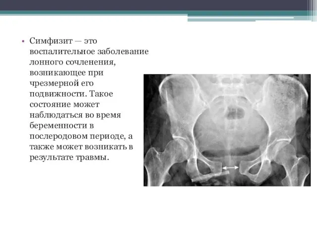 Симфизит — это воспалительное заболевание лонного сочленения, возникающее при чрезмерной его подвижности.