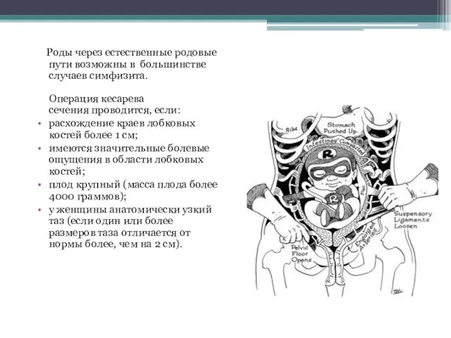 Роды через естественные родовые пути возможны в большинстве случаев симфизита. Операция кесарева