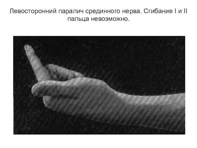 Левосторонний паралич срединного нерва. Сгибание I и II пальца невозможно.
