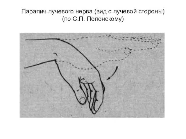 Паралич лучевого нерва (вид с лучевой стороны) (по С.П. Полонскому)