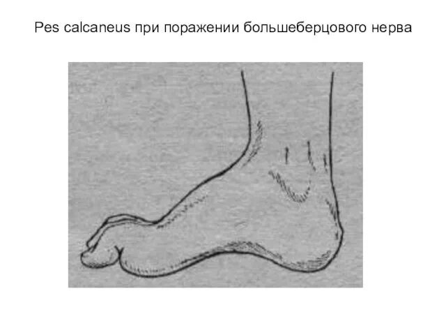 Pes calcaneus при поражении большеберцового нерва