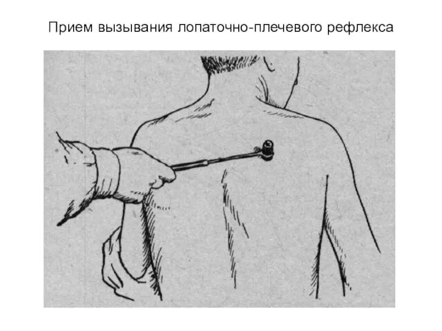 Прием вызывания лопаточно-плечевого рефлекса