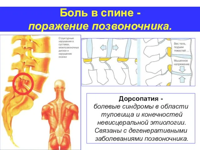 Боль в спине - поражение позвоночника. Дорсопатия - болевые синдромы в области