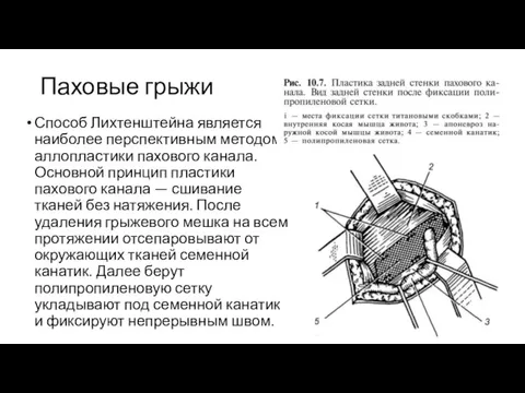 Паховые грыжи Способ Лихтенштейна является наиболее перспективным методом аллопластики пахового канала. Основной