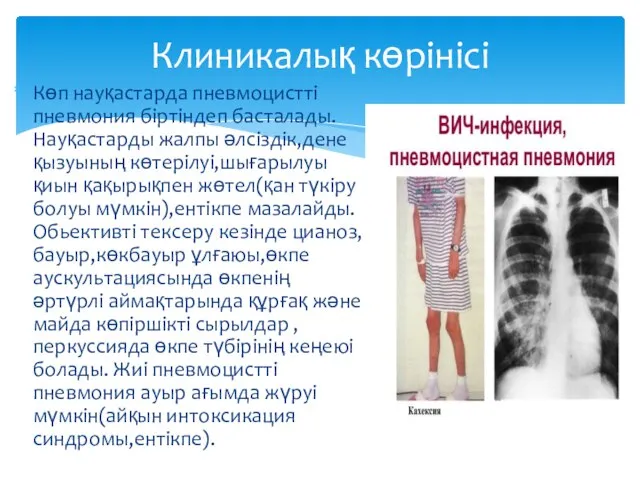 Клиникалық көрінісі Көп науқастарда пневмоцистті пневмония біртіндеп басталады. Науқастарды жалпы әлсіздік,дене қызуының