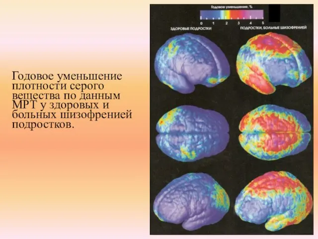 Годовое уменьшение плотности серого вещества по данным МРТ у здоровых и больных шизофренией подростков.