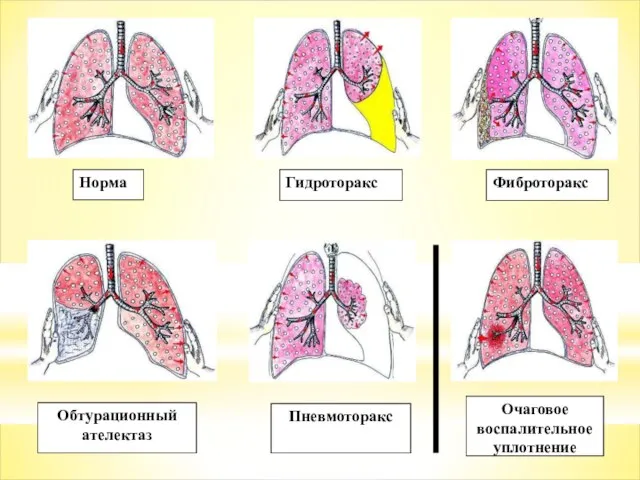 Норма Гидроторакс Фиброторакс Обтурационный ателектаз Очаговое воспалительное уплотнение Пневмоторакс