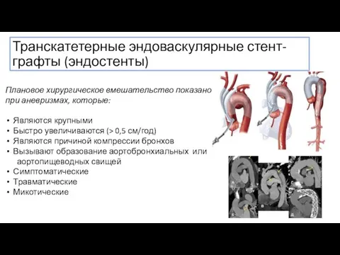 Транскатетерные эндоваскулярные стент-графты (эндостенты) Плановое хирургическое вмешательство показано при аневризмах, которые: Являются