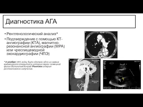 Диагностика АГА Рентгенологический анализ* Подтверждение с помощью КТ-ангиографии (КТА), магнитно-резонансной ангиографии (МРА)