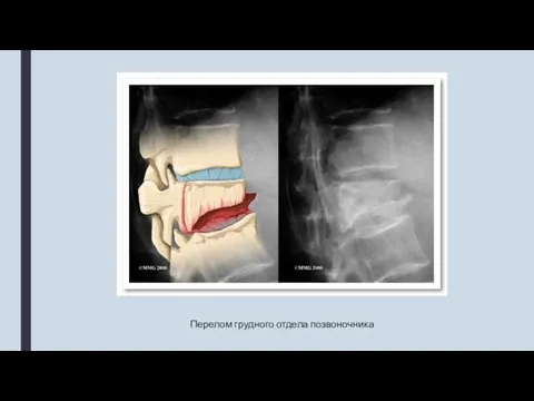 Перелом грудного отдела позвоночника