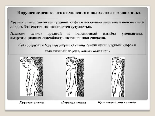 Нарушение осанки-это отклонения в положении позвоночника. Круглая спина: увеличен грудной кифоз и