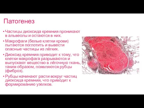 Патогенез Частицы диоксида кремния проникают в альвеолы и остаются в них. Макрофаги