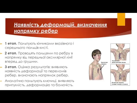 Наявність деформацій, визначення напрямку ребер 1 етап. Пальпують кінчиками вказівного і середнього