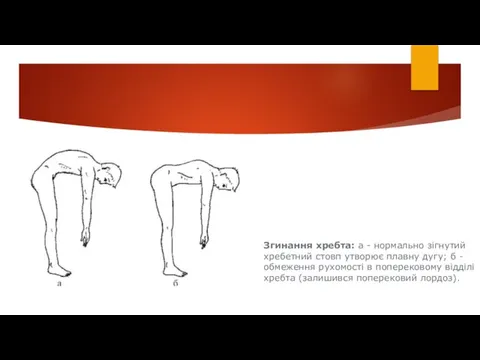 Згинання хребта: а - нормально зігнутий хребетний стовп утворює плавну дугу; б