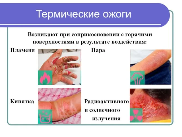 Термические ожоги Возникают при соприкосновении с горячими поверхностями в результате воздействия: Пламени